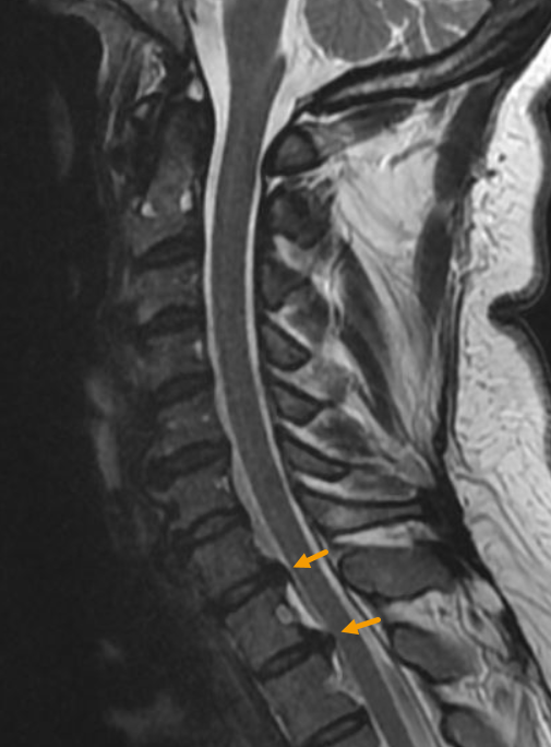 Sagittal cervical spine MRI with two gold arrows highlighting lower cervical disc regions for independent MRI image review.